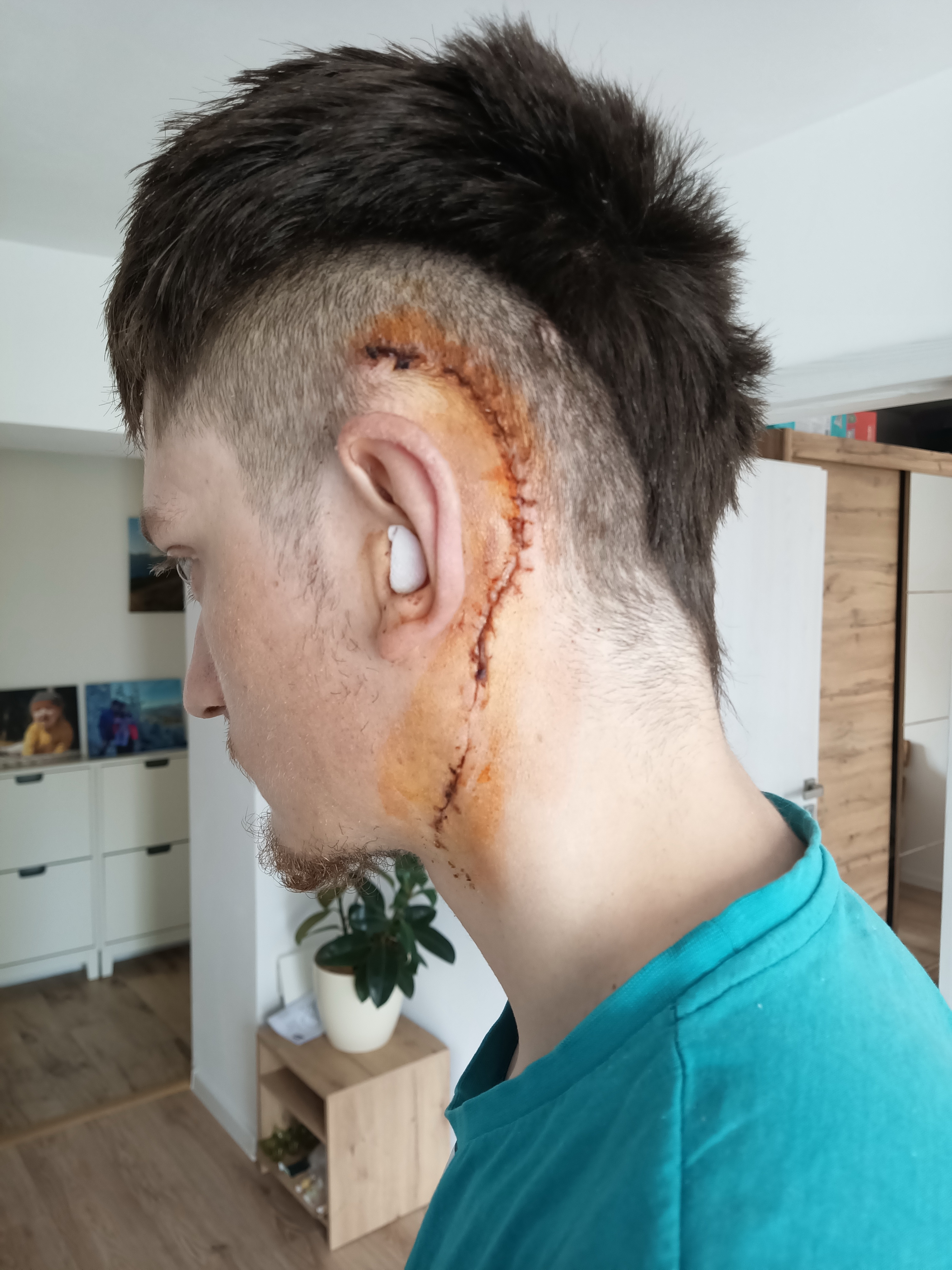 Doma po troch týždňoch v nemocnici prvý krát vidím pooperačný suvenír. Doma_po_troch_týždňoch_v_nemocnici_prvý_krát_vidím_pooperačný_suvenír.